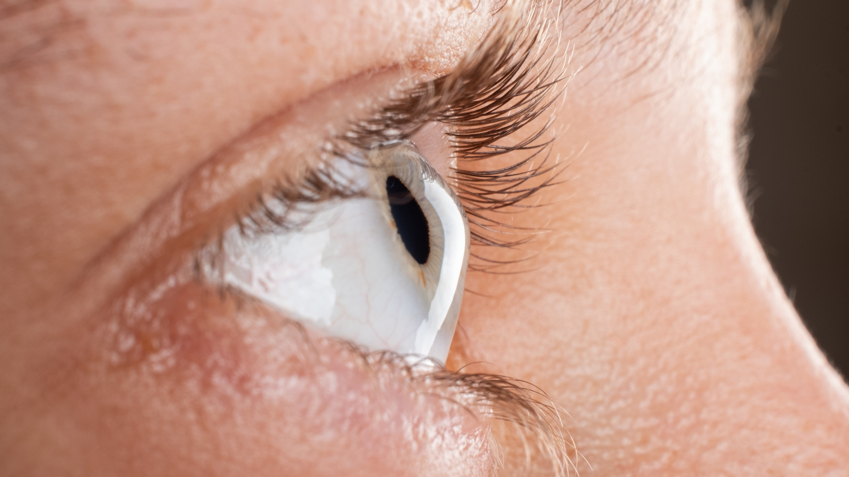 What is Keratoconus?