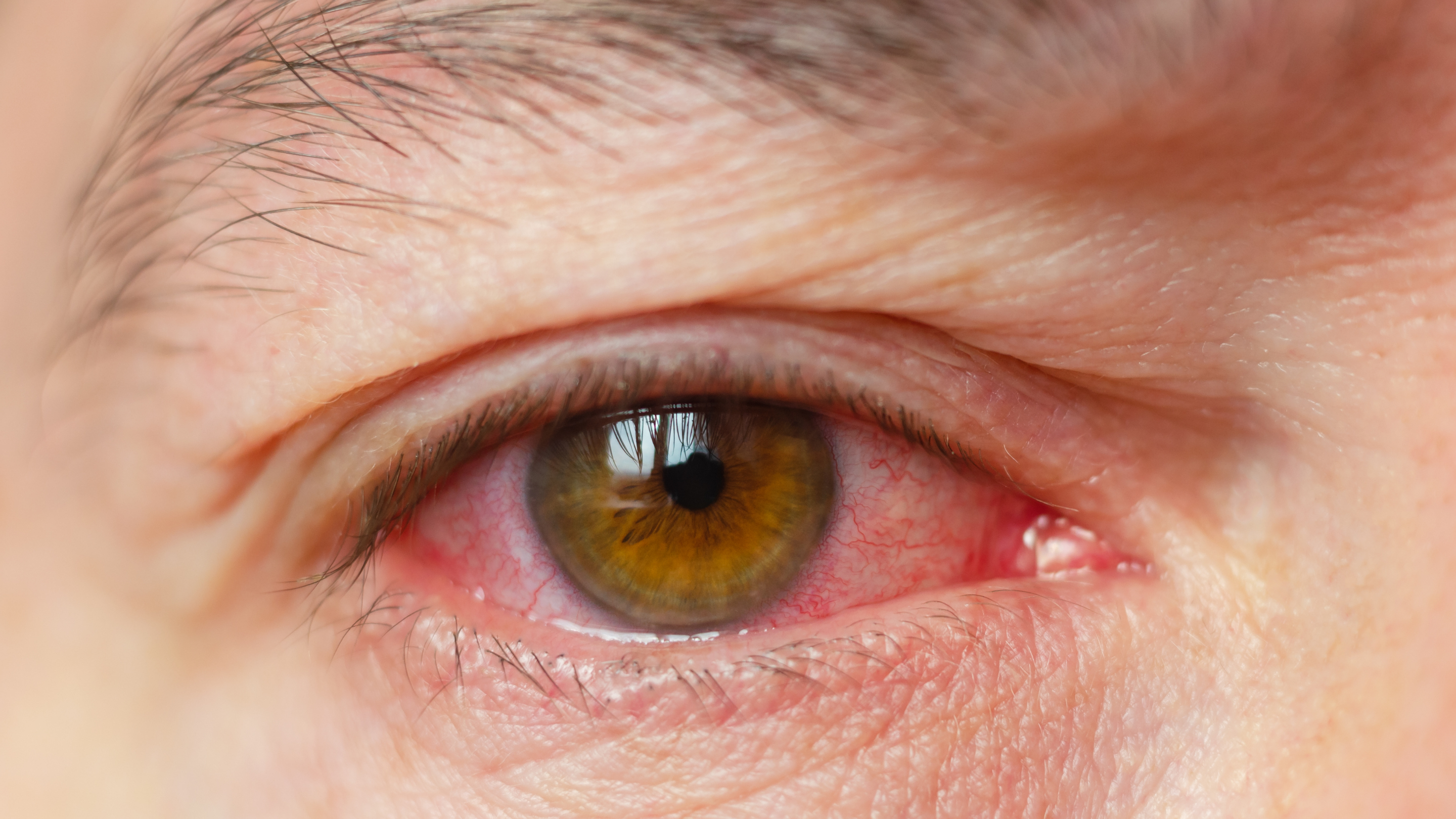 How to Prevent Eye Infections