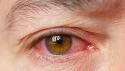 How to Prevent Eye Infections