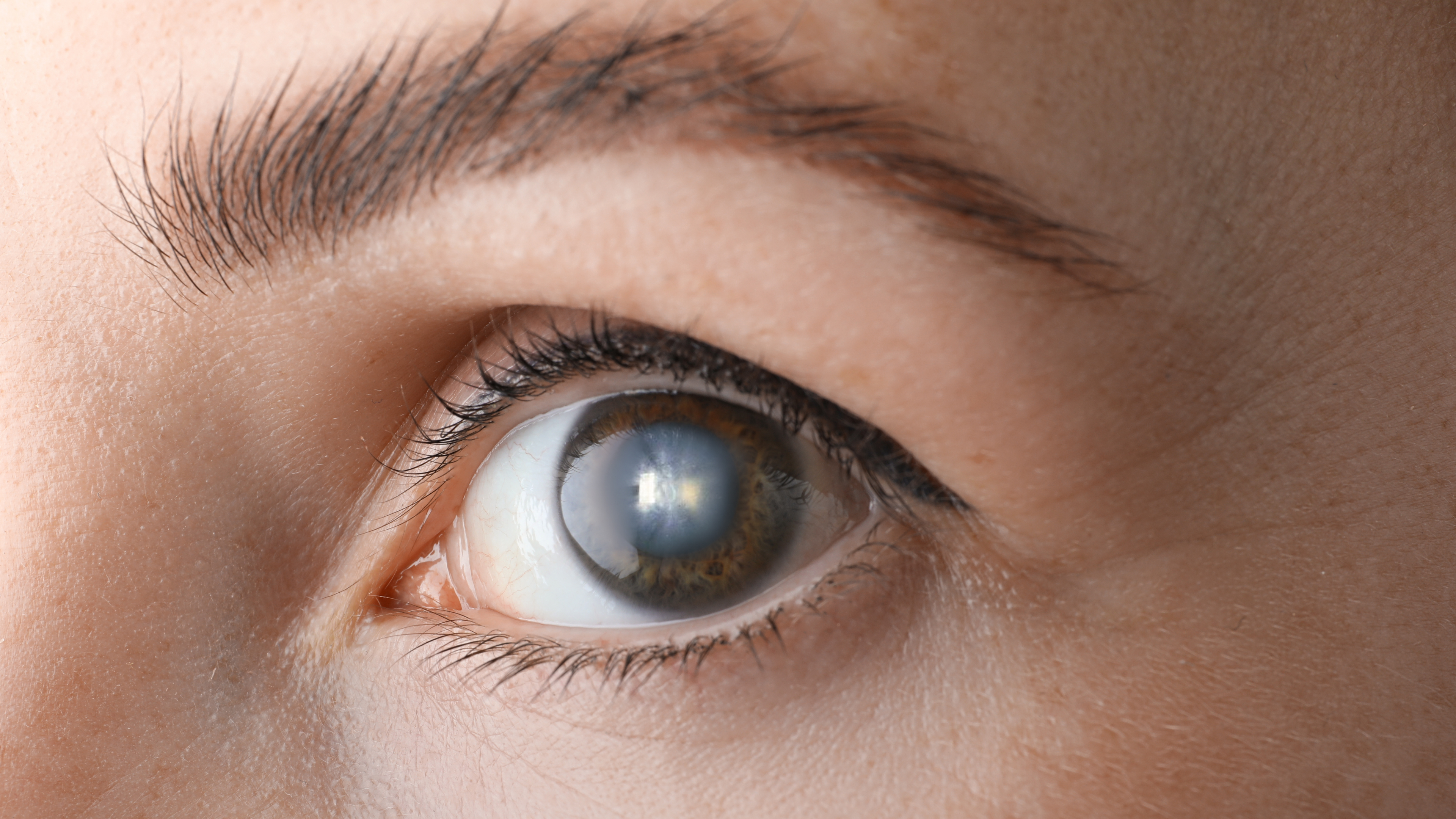 How Cataracts Affect the Eyes